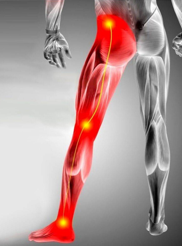 Sciatica-Relief